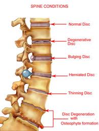 Patients With Degenerative Disc Disease In Montreal Benefit From Long-Term Healing At Clinique TAGMED