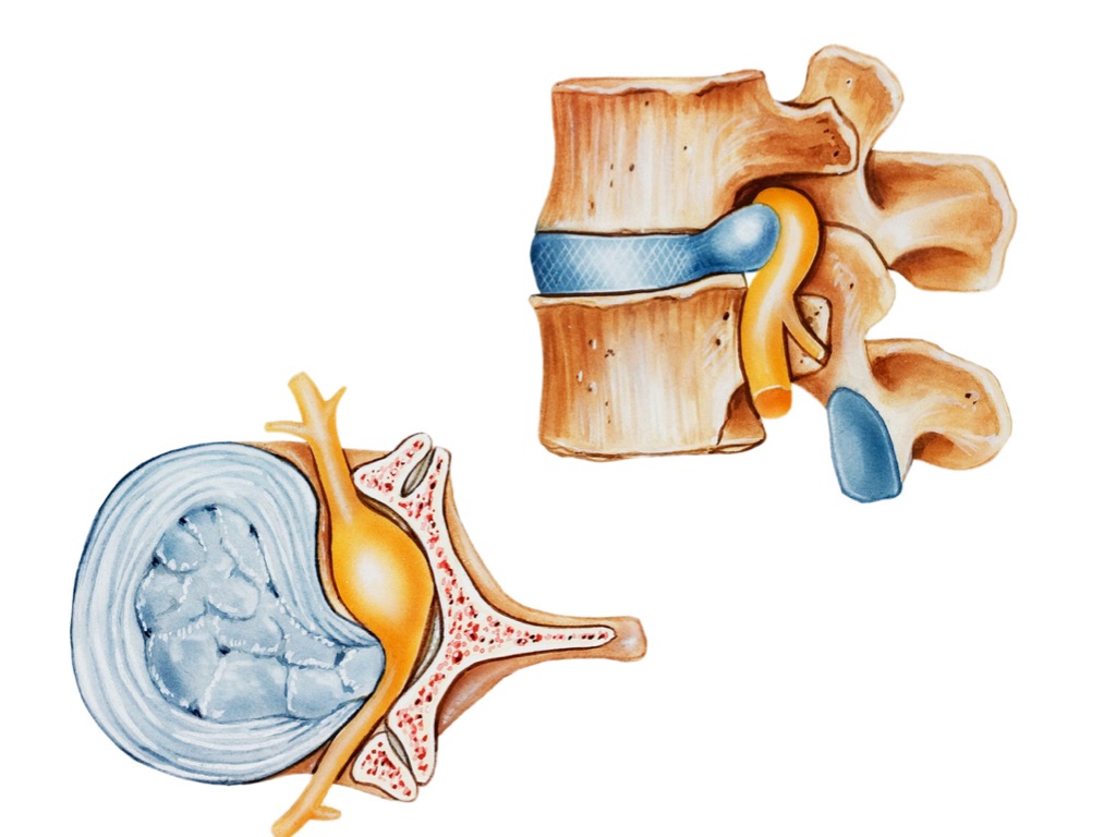 Clinical TAGMED Addresses The Unique Needs Of Degenerative Disc Disease Patients In Montreal