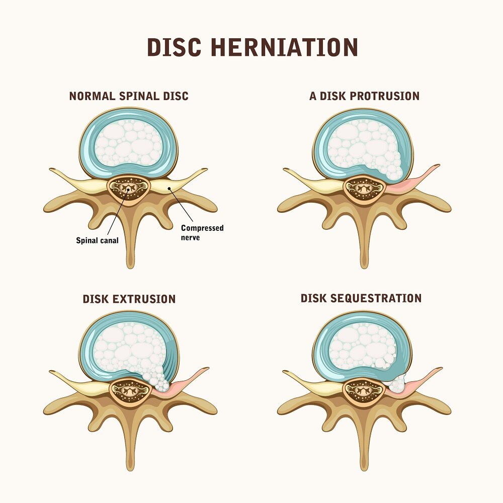 Patients Choose Clinique TAGMED For Bulging Disc Treatment In Montreal